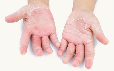 Dry hands from dog grooming